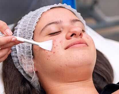 Peeling Qu&iacute;mico 